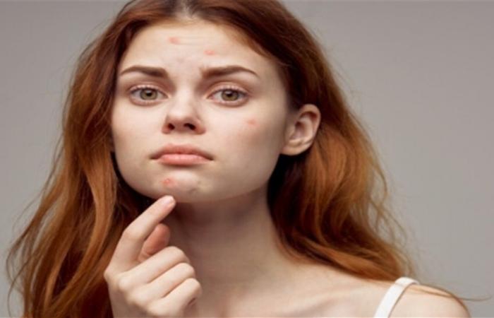 لماذا يزداد حب الشباب في الشتاء؟ حلول فعّالة للحفاظ على صحة البشرة