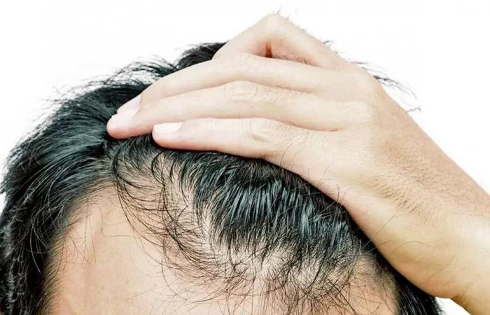 أسباب تساقط الشعر.. بين الوراثة والحالة الطبيّة